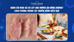 Bệnh sùi mào gà có lây qua đường ăn uống không