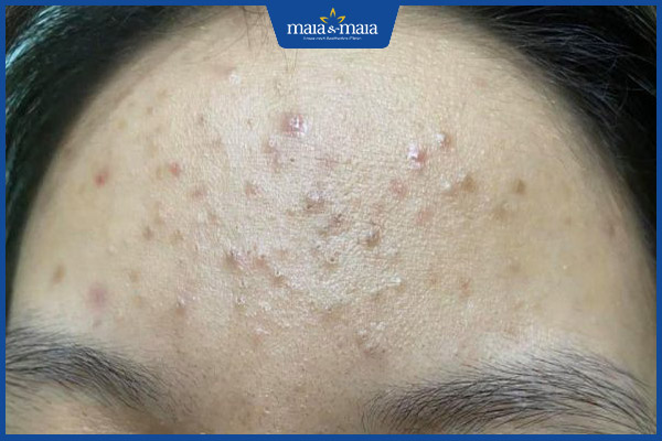 tình trạng mụn ẩn dưới da