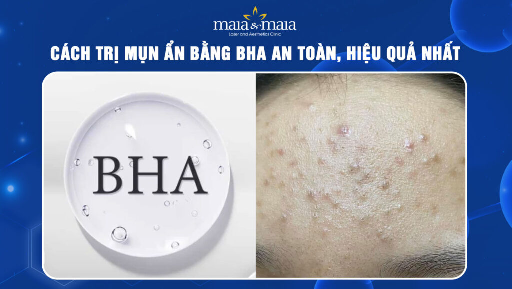 trị mụn ẩn bằng bha