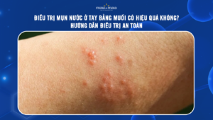 trị mụn nước ở tay bằng muối