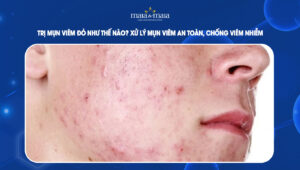 trị mụn viêm đỏ