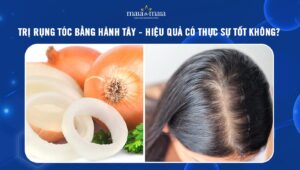 trị rụng tóc bằng hành tây