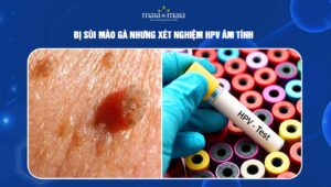 bị sùi mào gà nhưng xét nghiệm hpv âm tính