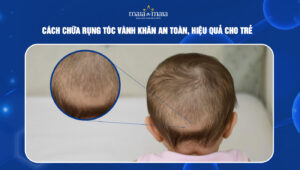 cách chữa rụng tóc vành khăn