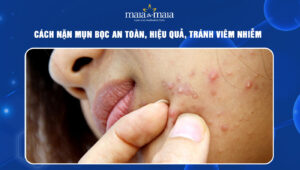 cách nặn mụn bọc