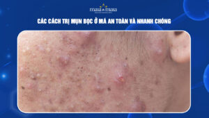 cách trị mụn bọc ở má