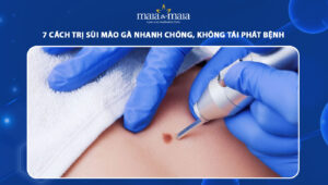 cách trị sùi mào gà