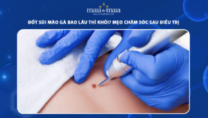 Đốt sùi mào gà bao lâu thì khỏi