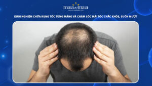 kinh nghiệm chữa rụng tóc từng mảng