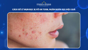 mụn bọc bị vỡ