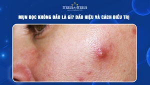 mụn bọc không đầu