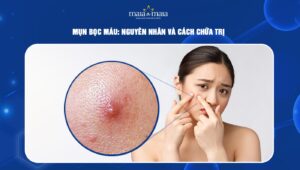 mụn bọc máu