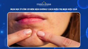 mụn bọc ở cằm có nên nặn không