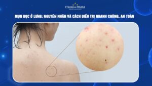 mụn bọc ở lưng