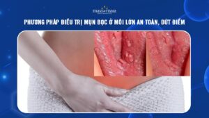mụn bọc ở môi lớn