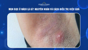 mụn bọc ở nách