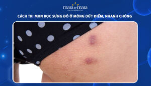 mụn bọc sưng đỏ ở mông