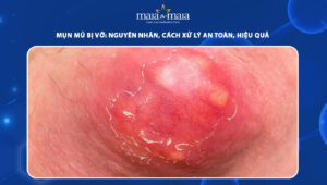 mụn mủ bị vỡ