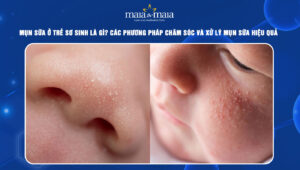 mụn sữa ở trẻ sơ sinh