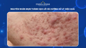 mụn thành sẹo lồi