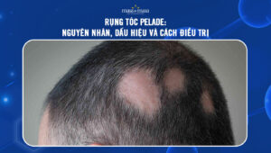 rụng tóc Pelade