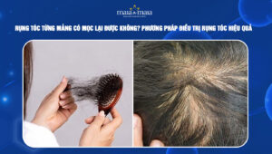 rụng tóc từng mảng có mọc lại được không