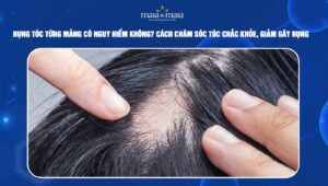 Rụng tóc từng mảng có nguy hiểm không