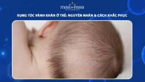 rụng tóc vành khăn