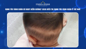 rụng tóc vành khăn có nguy hiểm không