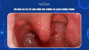 sùi mào gà có lây qua nước bọt không