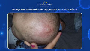 trẻ mọc mụn mủ trên đầu