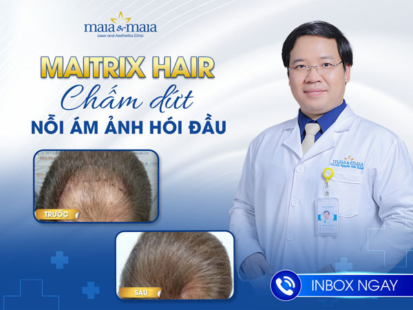 trị rụng tóc bằng maitrix hair