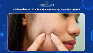 cách nặn mụn bọc bị chai cứng