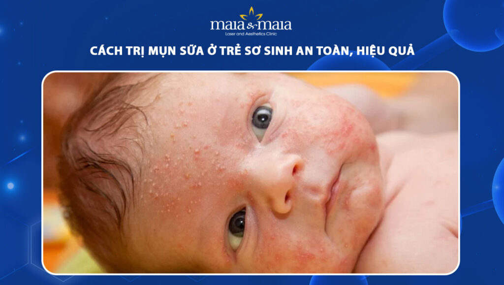 cách trị mụn sữa ở trẻ sơ sinh