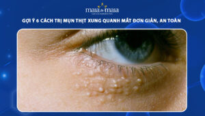 cách trị mụn thịt xung quanh mắt