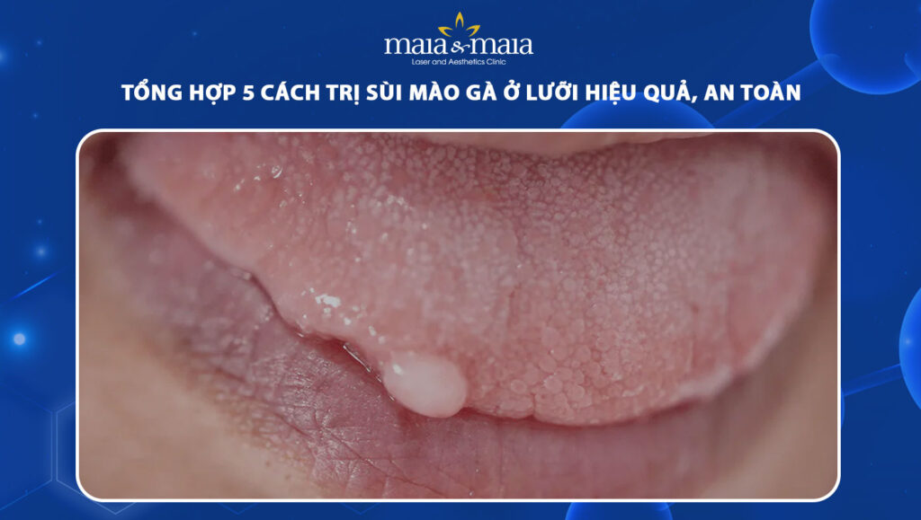 cách trị sùi mào gà ở lưỡi