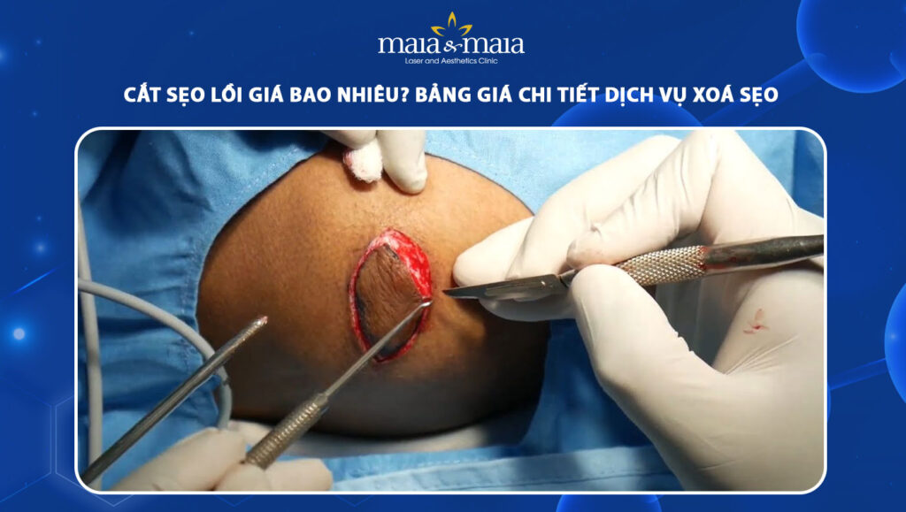 Cắt sẹo lồi giá bao nhiêu? Bảng giá chi tiết dịch vụ xoá sẹo 1 cắt sẹo lồi giá bao nhiêu