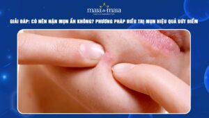 có nên nặn mụn ẩn không