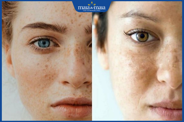 Nám và tàn nhang: Cách phân biệt, phương pháp điều trị 2 da mặt bị nám và tàn nhang