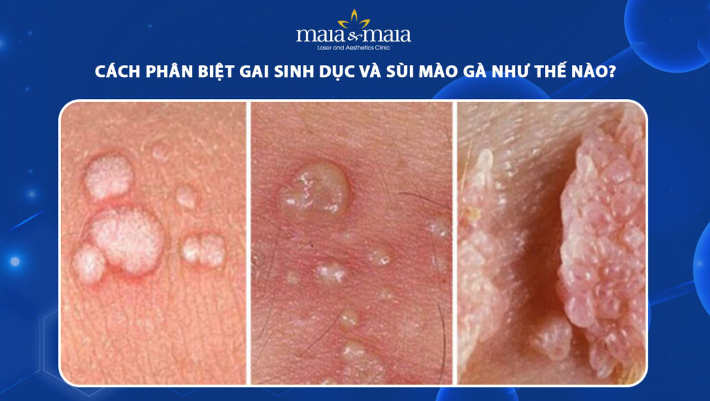 gai sinh dục và sùi mào gà