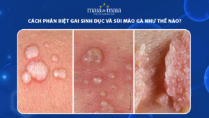 gai sinh dục và sùi mào gà