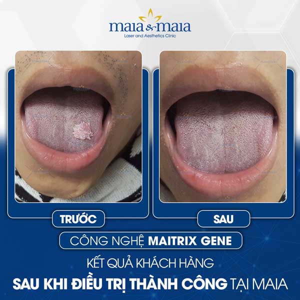 khách chữa sùi mào gà tại maia