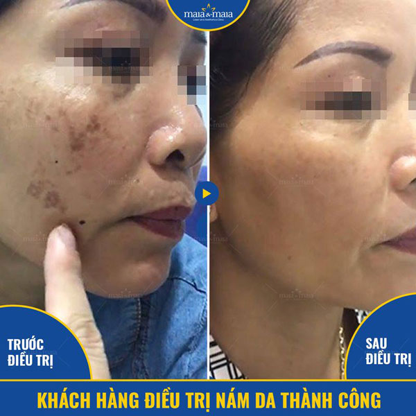 khách hàng chữa trị nám