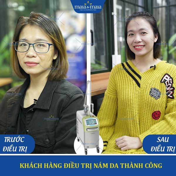 khách hàng điều trị nám thành công