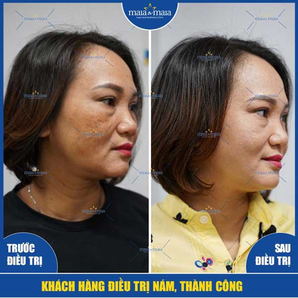 khách hàng điều trị nám