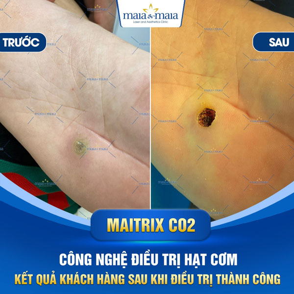 khách hàng trị mụn hạt cơm tại maia