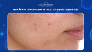 mụn ẩn nên dùng BHA hay Retinol