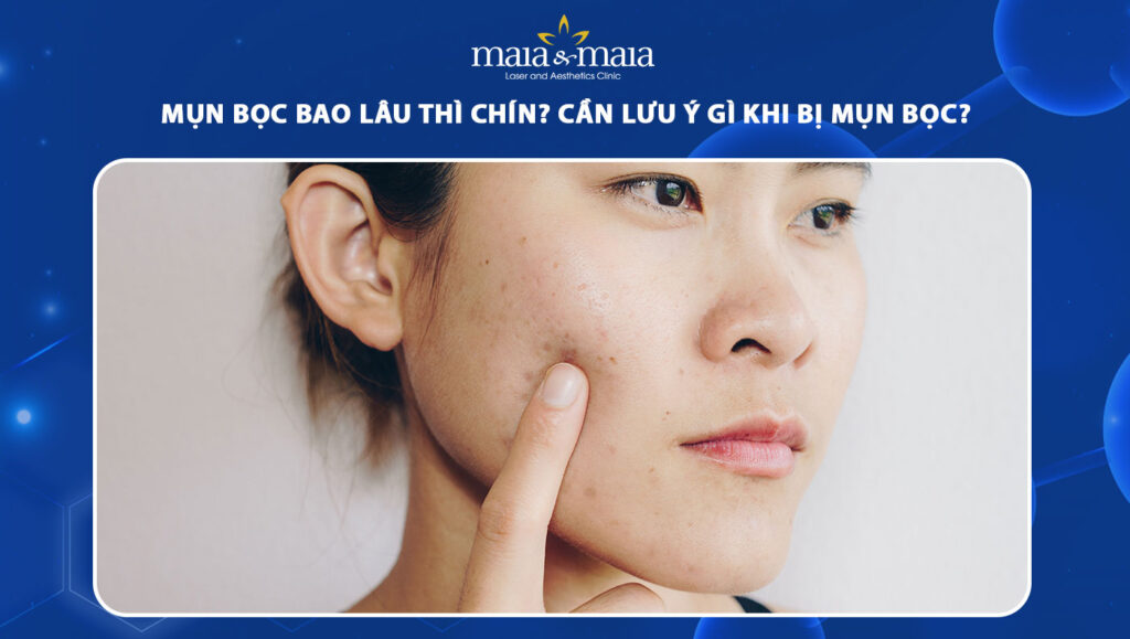 mụn bọc bao lâu thì chín