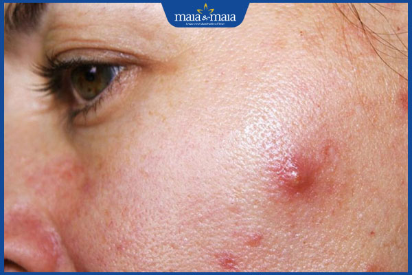 Hướng dẫn cách nặn mụn bọc bị chai cứng an toàn tại nhà 2 mụn bọc bị chai cứng