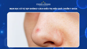 mụn bọc có tự xẹp không